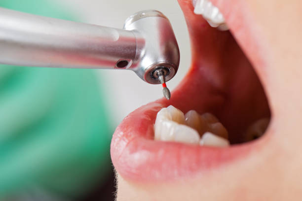 Best Emergency Root Canal Treatment in Calhoun City, MS